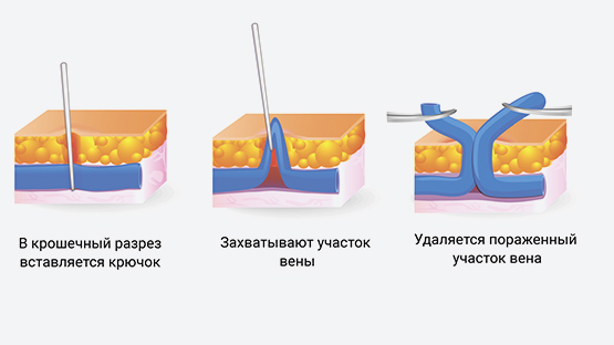 Минифлебэктомия - лечение варикозной болезни в Барнауле